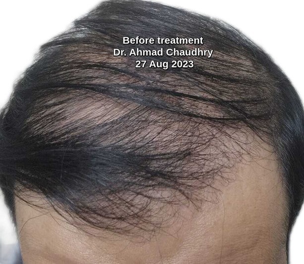 Hair transplant Rawalpindi Pakistan