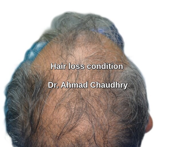 How much does hair transplant cost Lahore