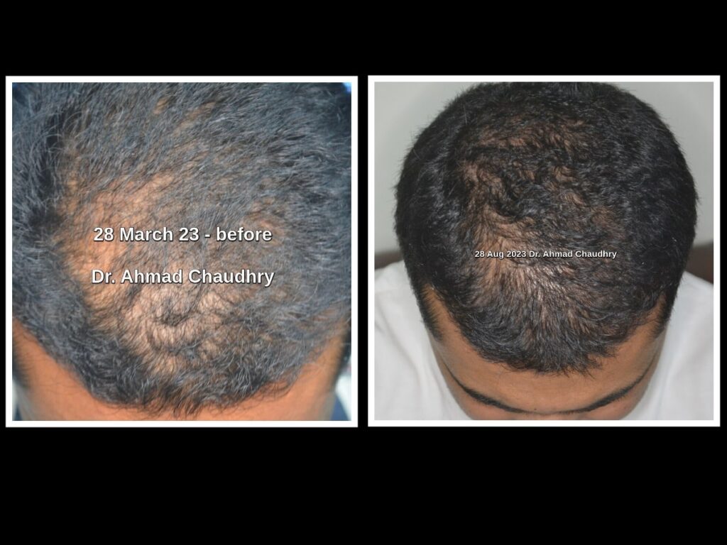 PRF hair loss treatment Lahore Pakistan