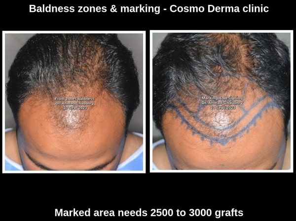 Baldness treatment Fue method Germany