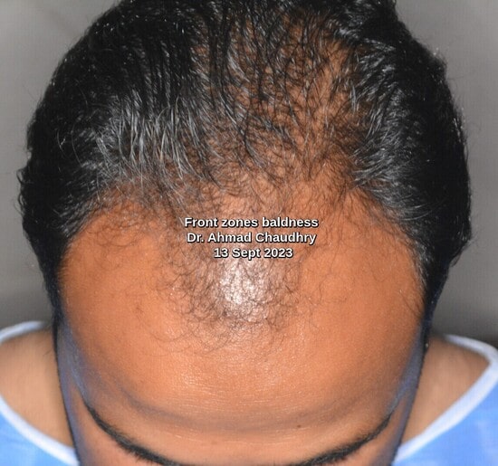 Hair loss treatment Frankfurt