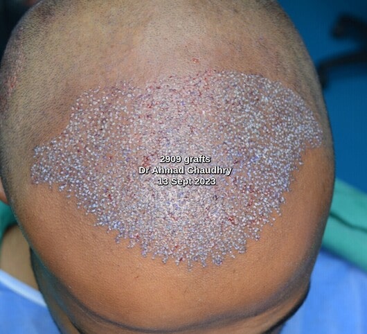 Hair transplant Frankfurt Germany patient