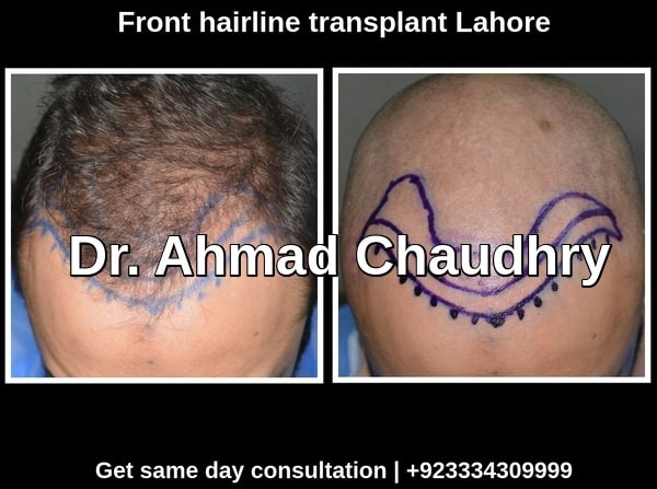 Hair transplant Johar town Lahore