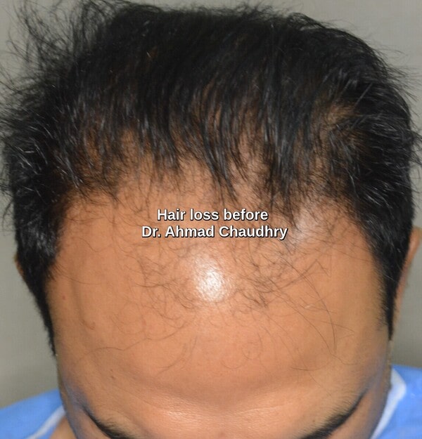 Hair transplant Surrey