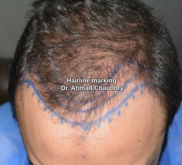 Receding hairline treatment Lahore patient