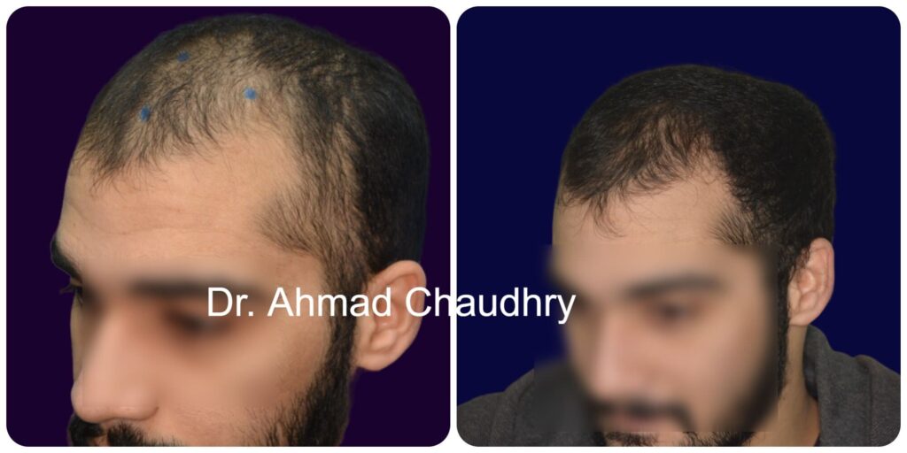 Best hair regrowth treatment result Lahore