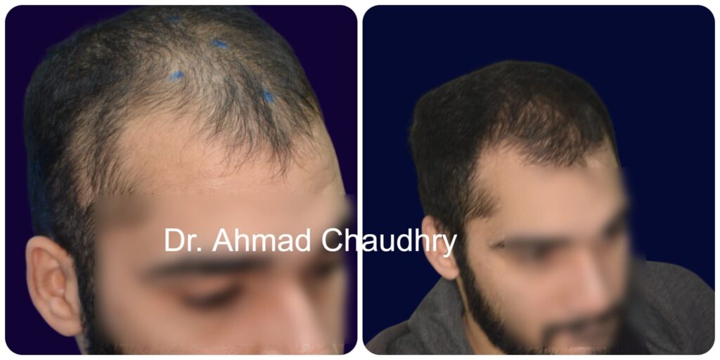 Hair loss treatment Pakistan right vi