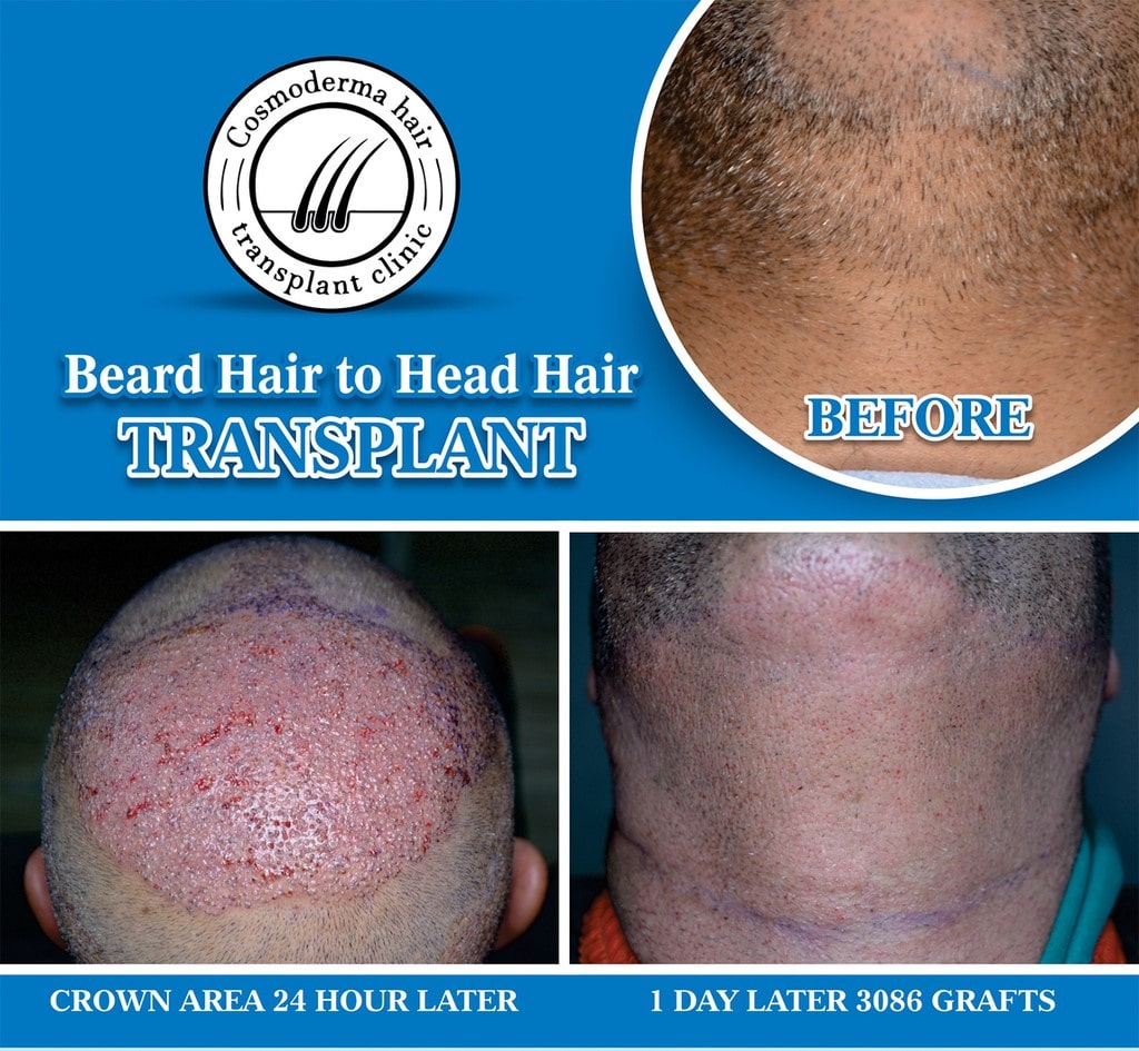 Hair transplant Paris patient